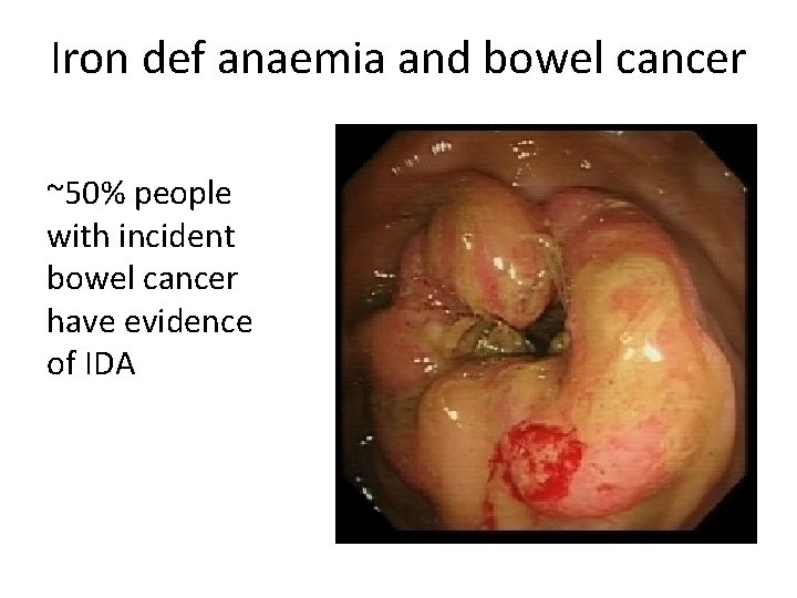 Iron def anaemia and bowel cancer ~50% people with incident bowel cancer have evidence Iron def anaemia and bowel cancer ~50% people with incident bowel cancer have evidence