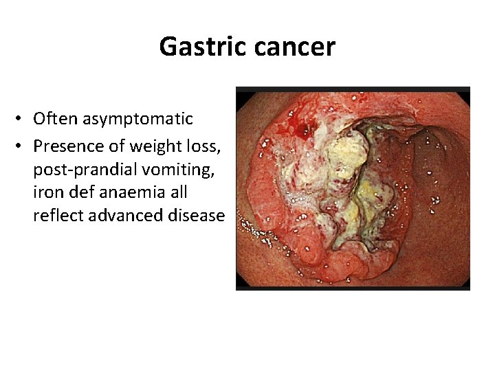 Gastric cancer • Often asymptomatic • Presence of weight loss, post-prandial vomiting, iron def Gastric cancer • Often asymptomatic • Presence of weight loss, post-prandial vomiting, iron def