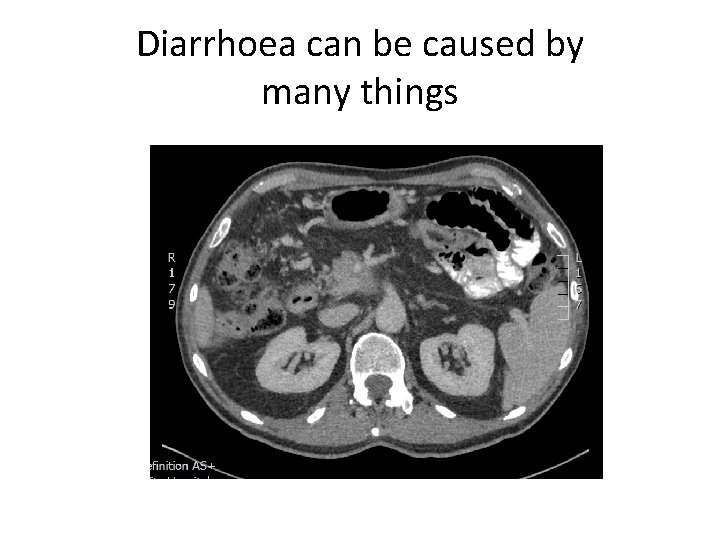 Diarrhoea can be caused by many things Diarrhoea can be caused by many things