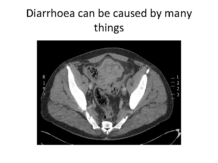 Diarrhoea can be caused by many things Diarrhoea can be caused by many things