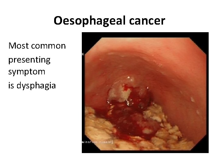 Oesophageal cancer Most common presenting symptom is dysphagia Oesophageal cancer Most common presenting symptom is dysphagia