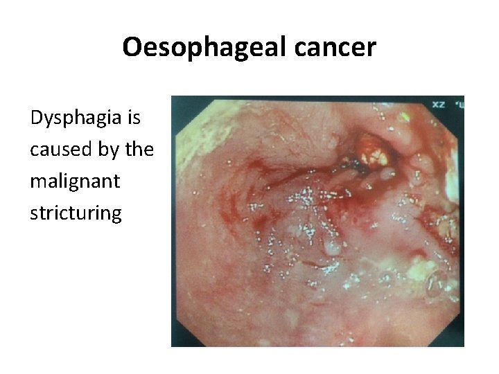 Oesophageal cancer Dysphagia is caused by the malignant stricturing Oesophageal cancer Dysphagia is caused by the malignant stricturing
