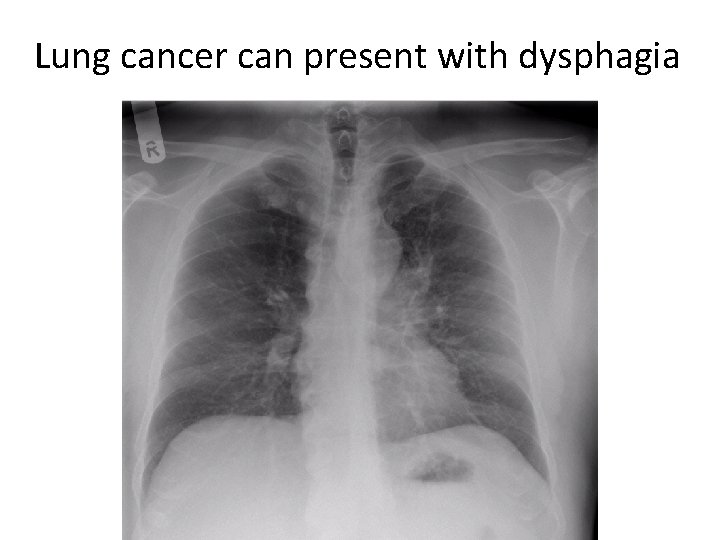 Lung cancer can present with dysphagia Lung cancer can present with dysphagia