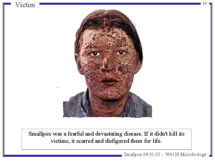 Victim 14 Smallpox was a fearful and devastating disease. If it didn't kill its Victim 14 Smallpox was a fearful and devastating disease. If it didn't kill its