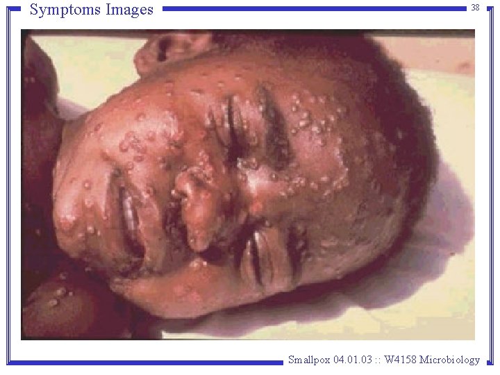 Symptoms Images 38 Smallpox 04. 01. 03 : : W 4158 Microbiology Symptoms Images 38 Smallpox 04. 01. 03 : : W 4158 Microbiology