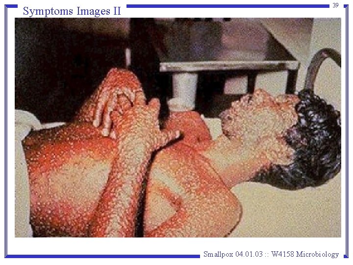 Symptoms Images II 39 Smallpox 04. 01. 03 : : W 4158 Microbiology Symptoms Images II 39 Smallpox 04. 01. 03 : : W 4158 Microbiology