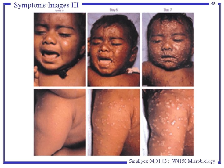 Symptoms Images III 40 Smallpox 04. 01. 03 : : W 4158 Microbiology Symptoms Images III 40 Smallpox 04. 01. 03 : : W 4158 Microbiology