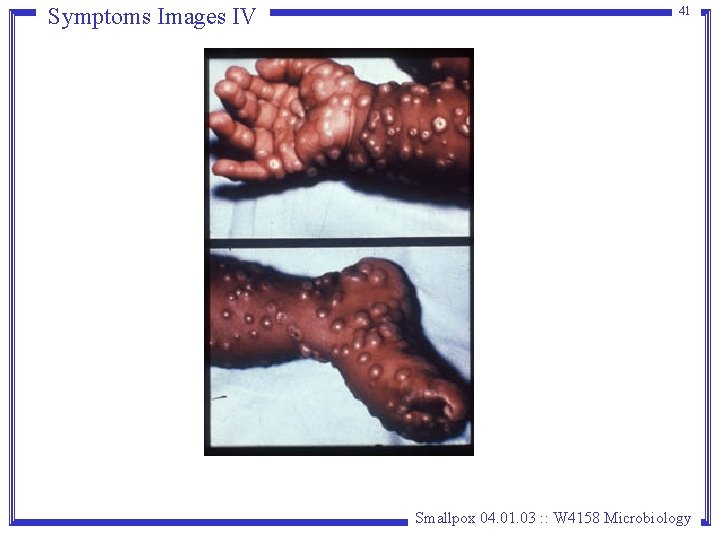 Symptoms Images IV 41 Smallpox 04. 01. 03 : : W 4158 Microbiology Symptoms Images IV 41 Smallpox 04. 01. 03 : : W 4158 Microbiology
