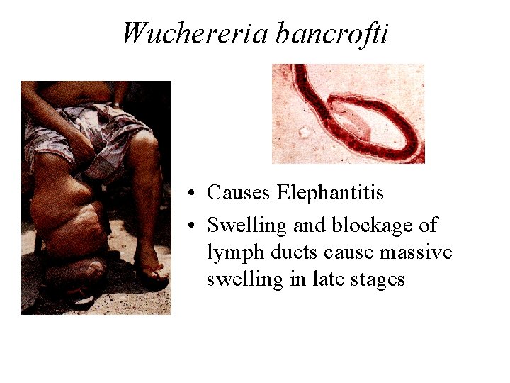 Wuchereria bancrofti • Causes Elephantitis • Swelling and blockage of lymph ducts cause massive Wuchereria bancrofti • Causes Elephantitis • Swelling and blockage of lymph ducts cause massive