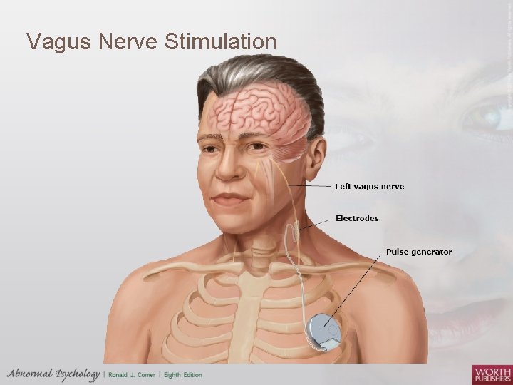 Vagus Nerve Stimulation 