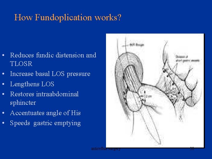 How Fundoplication works? • Reduces fundic distension and TLOSR • Increase basal LOS pressure