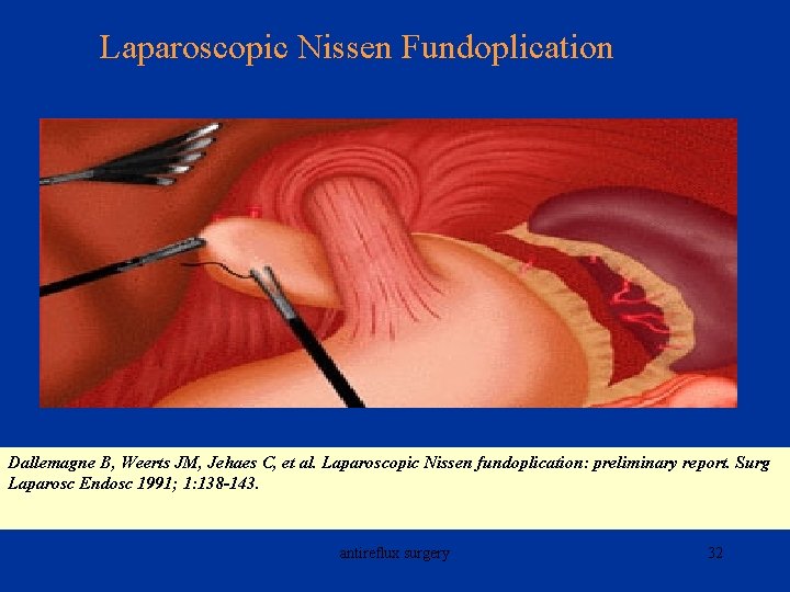 Laparoscopic Nissen Fundoplication Dallemagne B, Weerts JM, Jehaes C, et al. Laparoscopic Nissen fundoplication: