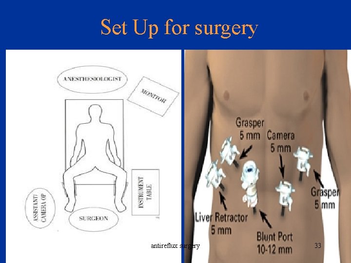 Set Up for surgery antireflux surgery 33 