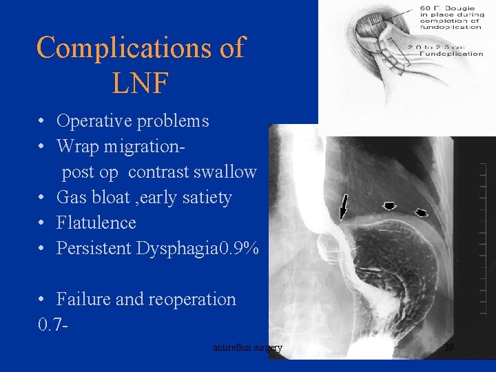 Complications of LNF • Operative problems • Wrap migration- post op contrast swallow •