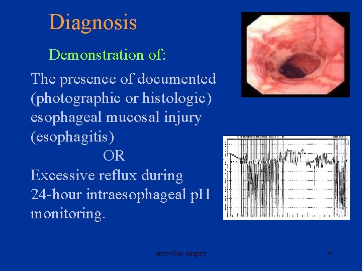 Diagnosis Demonstration of: The presence of documented (photographic or histologic) esophageal mucosal injury (esophagitis)