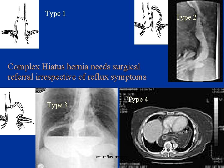 Type 1 Type 2 Complex Hiatus hernia needs surgical referral irrespective of reflux symptoms