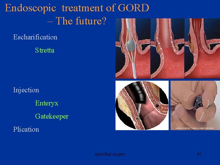 Endoscopic treatment of GORD – The future? Escharification Stretta Injection Enteryx Gatekeeper Plication antireflux