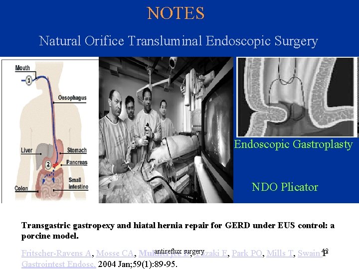 NOTES Natural Orifice Transluminal Endoscopic Surgery Endoscopic Gastroplasty NDO Plicator Transgastric gastropexy and hiatal