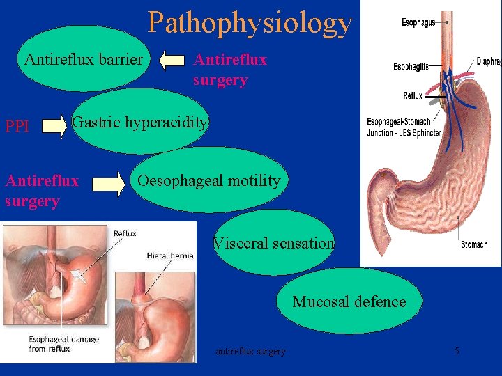 Pathophysiology Antireflux barrier PPI Antireflux surgery Gastric hyperacidity Antireflux surgery Oesophageal motility Visceral sensation