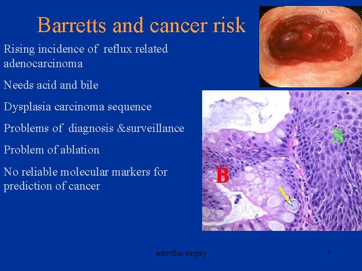 Barretts and cancer risk Rising incidence of reflux related adenocarcinoma Needs acid and bile