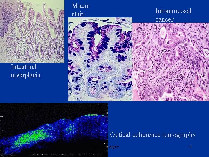 Mucin stain Intramucosal cancer Intestinal metaplasia Optical coherence tomography antireflux surgery 8 