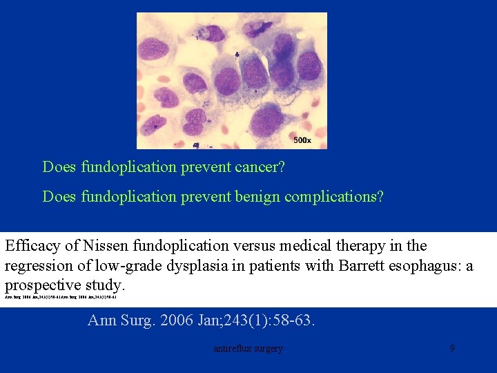 Does fundoplication prevent cancer? Does fundoplication prevent benign complications? Efficacy of Nissen fundoplication versus