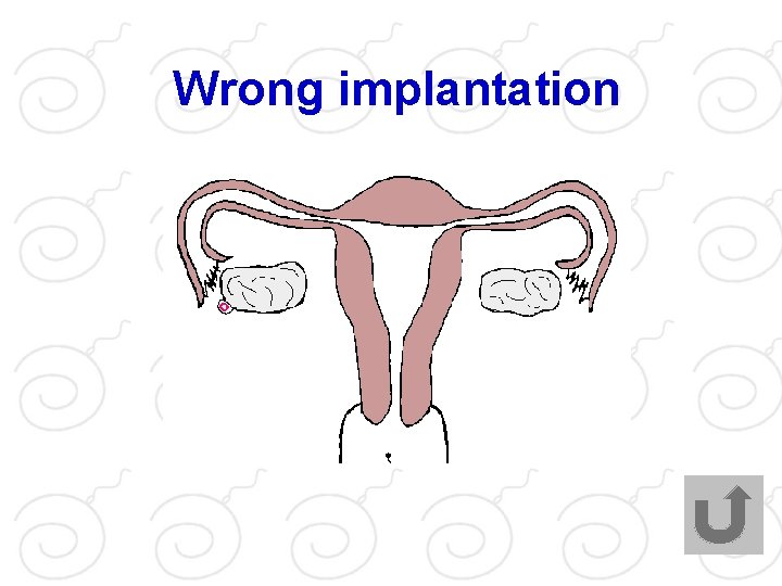 Wrong implantation 