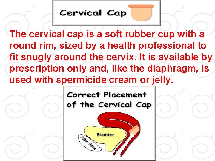 The cervical cap is a soft rubber cup with a round rim, sized by