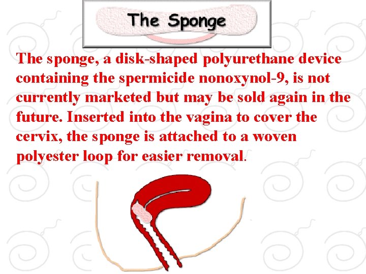 Sponge. The sponge, a disk-shaped polyurethane device containing the spermicide nonoxynol-9, is not currently