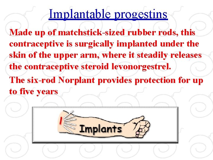 Implantable progestins Made up of matchstick-sized rubber rods, this contraceptive is surgically implanted under