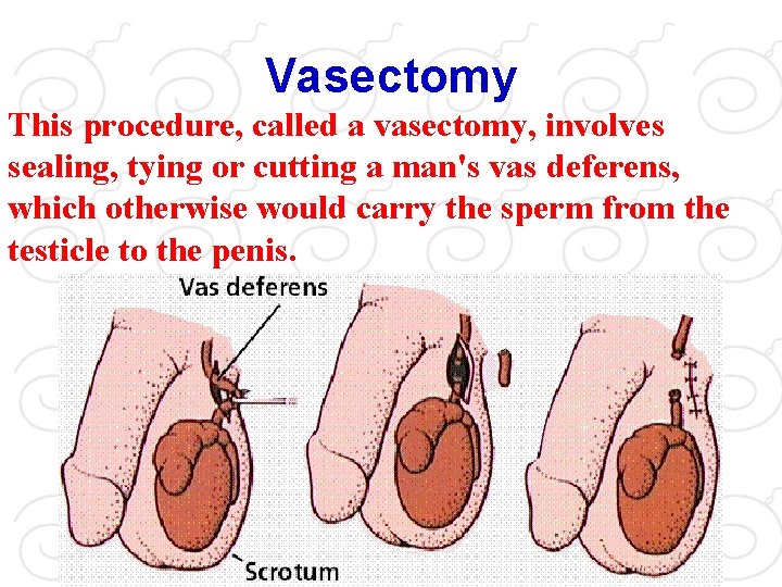 Vasectomy This procedure, called a vasectomy, involves sealing, tying or cutting a man's vas