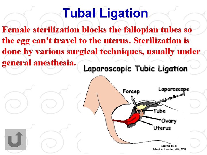 Tubal Ligation Female sterilization blocks the fallopian tubes so the egg can't travel to