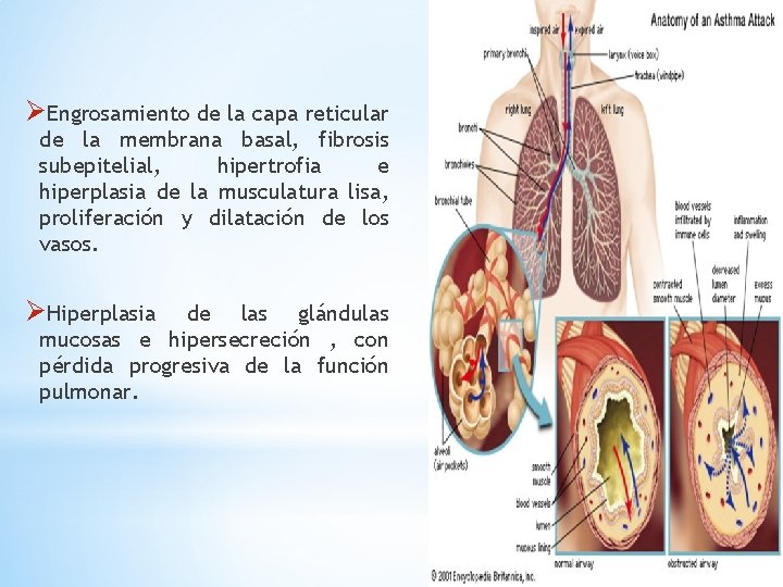 ØEngrosamiento de la capa reticular de la membrana basal, fibrosis subepitelial, hipertrofia e hiperplasia