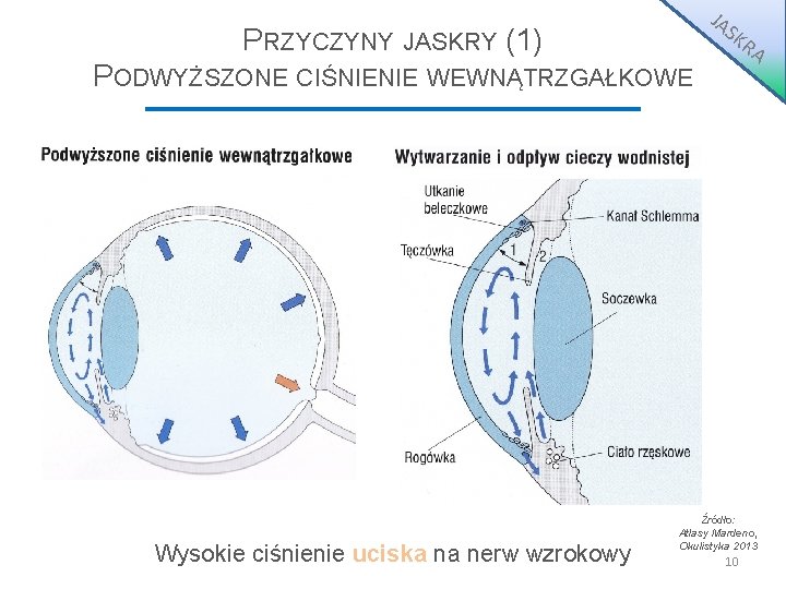 PRZYCZYNY JASKRY (1) PODWYŻSZONE CIŚNIENIE WEWNĄTRZGAŁKOWE Wysokie ciśnienie uciska na nerw wzrokowy JA S PRZYCZYNY JASKRY (1) PODWYŻSZONE CIŚNIENIE WEWNĄTRZGAŁKOWE Wysokie ciśnienie uciska na nerw wzrokowy JA S