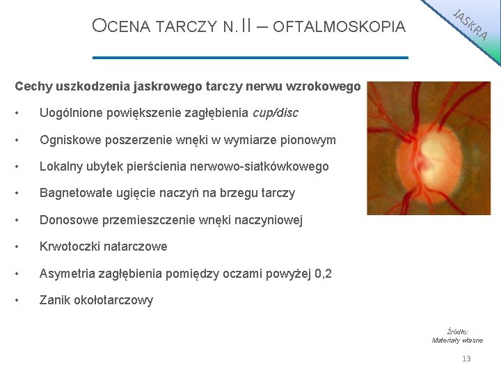 OCENA TARCZY N. II – OFTALMOSKOPIA JA S KR A Cechy uszkodzenia jaskrowego tarczy