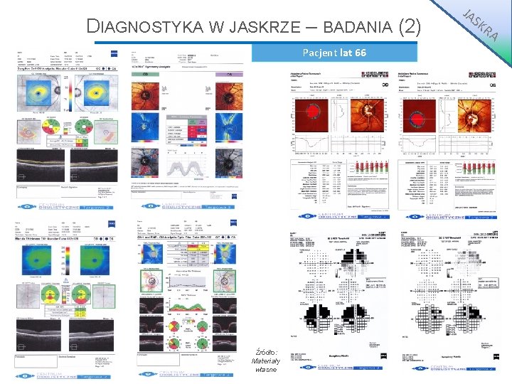 DIAGNOSTYKA W JASKRZE – BADANIA (2) Pacjent lat 66 Źródło: Materiały własne JA S