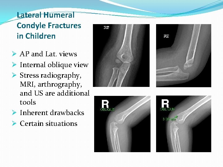 Lateral Humeral Condyle Fractures in Children Ø AP and Lat. views Ø Internal oblique Lateral Humeral Condyle Fractures in Children Ø AP and Lat. views Ø Internal oblique