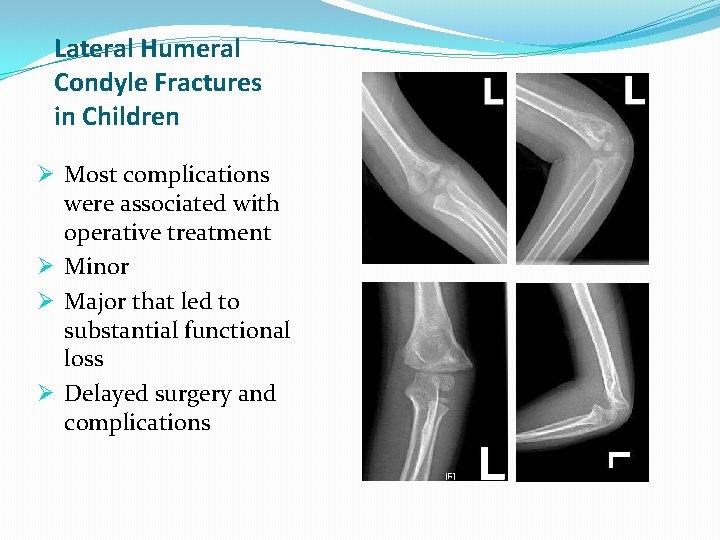 Lateral Humeral Condyle Fractures in Children Ø Most complications were associated with operative treatment Lateral Humeral Condyle Fractures in Children Ø Most complications were associated with operative treatment