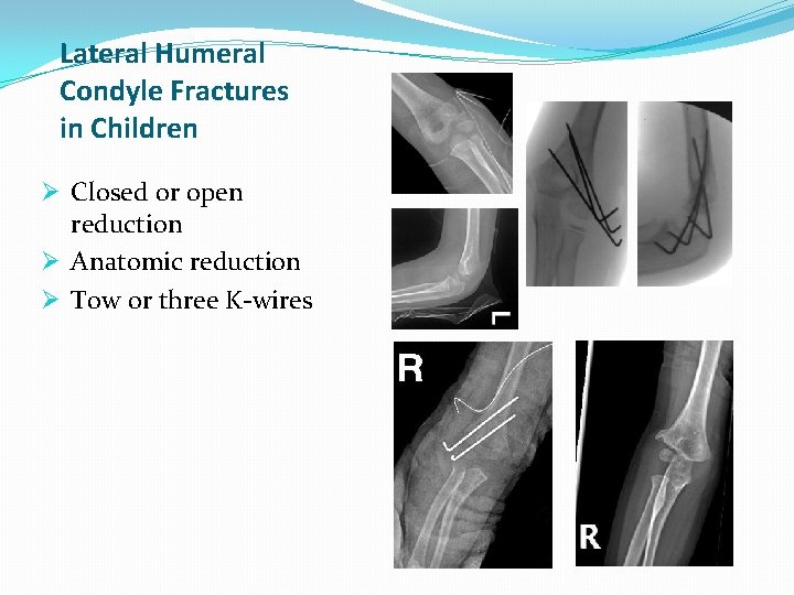 Lateral Humeral Condyle Fractures in Children Ø Closed or open reduction Ø Anatomic reduction Lateral Humeral Condyle Fractures in Children Ø Closed or open reduction Ø Anatomic reduction