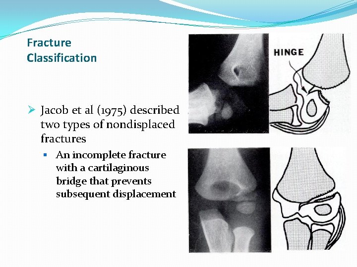 Fracture Classification Ø Jacob et al (1975) described two types of nondisplaced fractures § Fracture Classification Ø Jacob et al (1975) described two types of nondisplaced fractures §