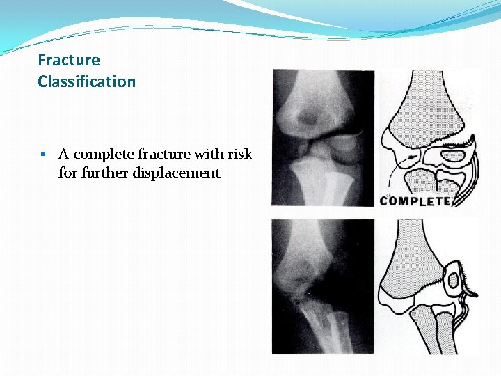 Fracture Classification § A complete fracture with risk for further displacement Fracture Classification § A complete fracture with risk for further displacement