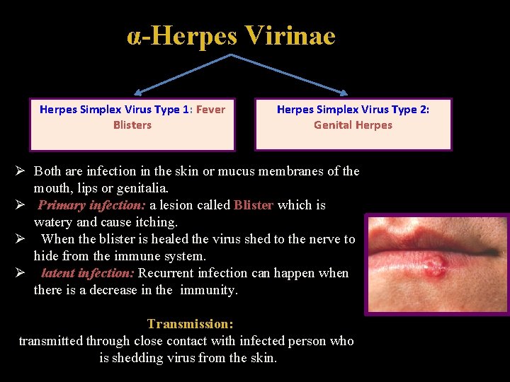 α-Herpes Virinae Herpes Simplex Virus Type 1: Fever Blisters Herpes Simplex Virus Type 2: