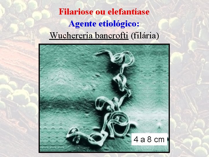 Filariose ou elefantíase Agente etiológico: Wuchereria bancrofti (filária) 4 a 8 cm 