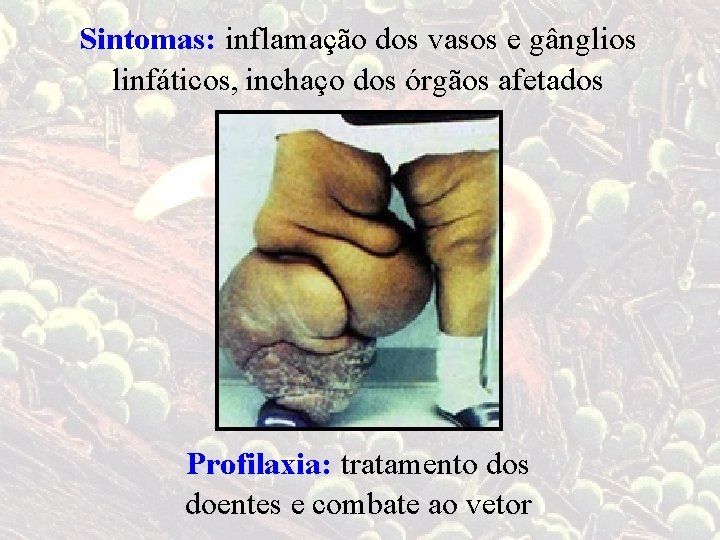 Sintomas: inflamação dos vasos e gânglios linfáticos, inchaço dos órgãos afetados Profilaxia: tratamento dos