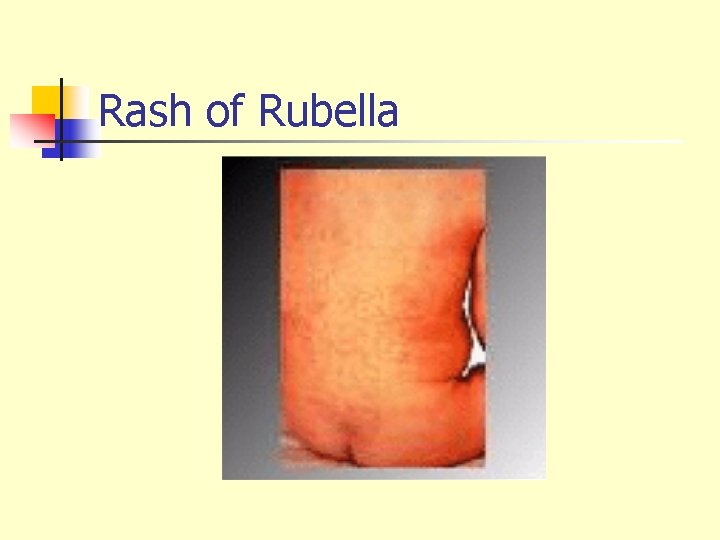 Rash of Rubella 