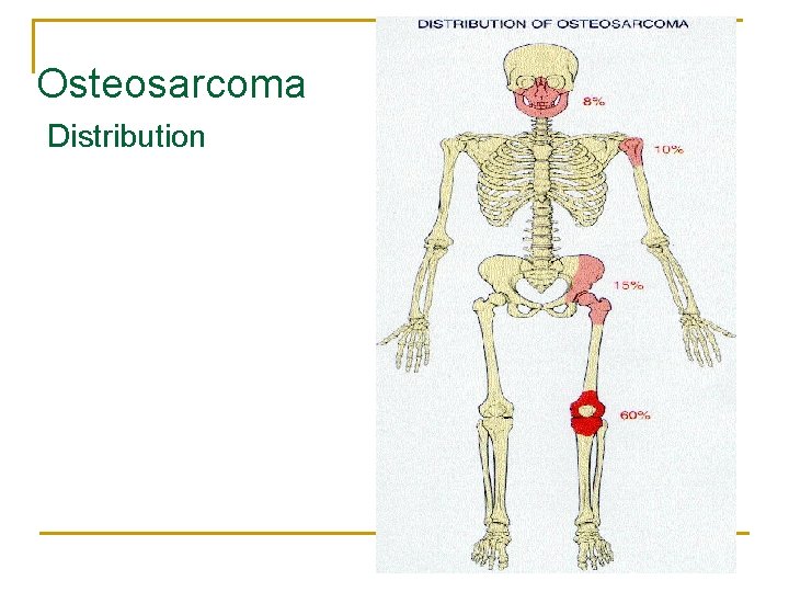 Osteosarcoma Distribution 