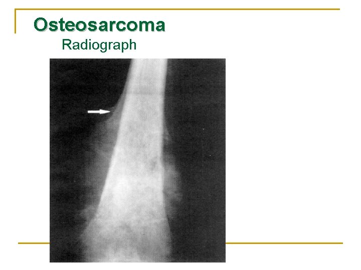 Osteosarcoma Radiograph 