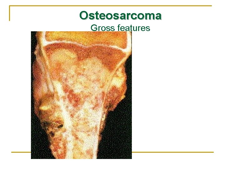 Osteosarcoma Gross features 