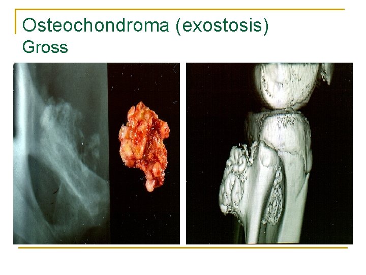 Osteochondroma (exostosis) Gross 