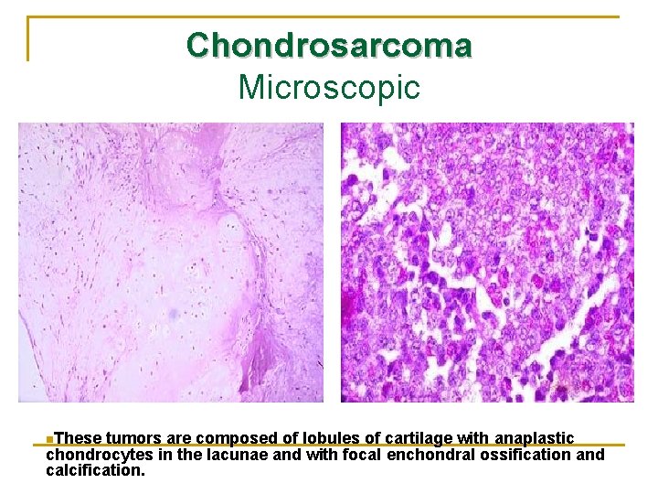 Chondrosarcoma Microscopic n. These tumors are composed of lobules of cartilage with anaplastic chondrocytes